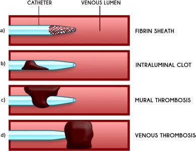 central venous catheter related thrombosis  children  adults