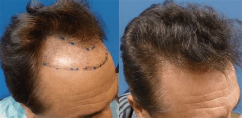 Can Smoking Cause Hair Loss? | Hair Restoration Specialists ...