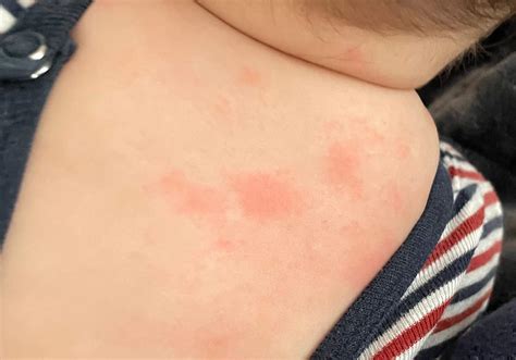 Ausschlag oder doch Allergie? (Haut, Hitze)