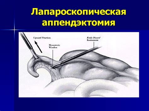 Острый аппендицит - презентация онлайн