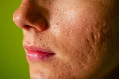 Understanding Acne Scars - Reviva Labs