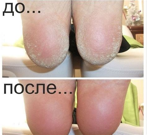 Гелевые носки для пяток. Цена 55 грн. Купить Оригинал.