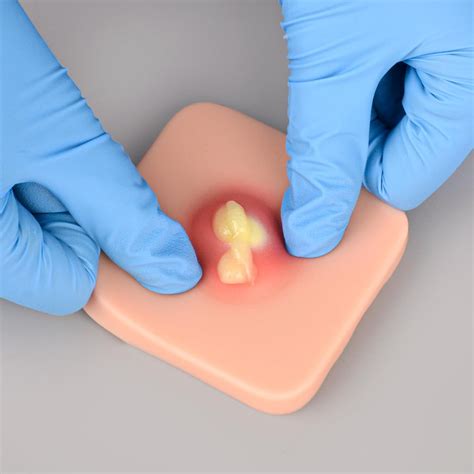 abscess id incision  drainage practice pad medarchitect
