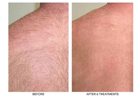 face hair removal laser near me 10