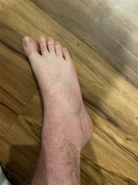 Rolled my ankle on a curb tonight and now my foot looks like this. Is