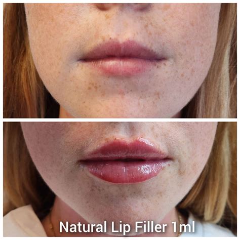 Lip Fillers London | Belle Clinic London