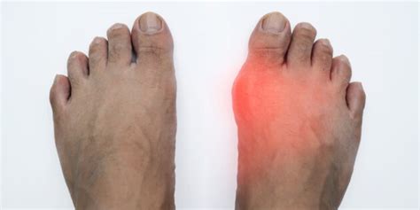 gout symptoms   relief options