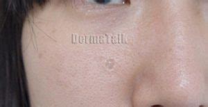 Desmoplastic Trichoepithelioma - dermRounds Dermatology Network