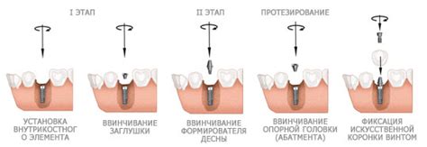 Формирователь десны при имплантации — порядок установки и материалы для ...