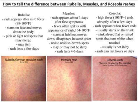 peds infectious diseases    flashcards quizlet