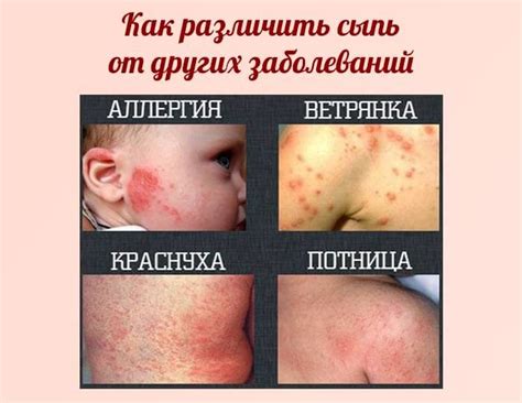 Причины появления на животе и спине у ребенка мелкой сыпи, симптоматика ...