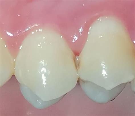 cavity forming raskadentist