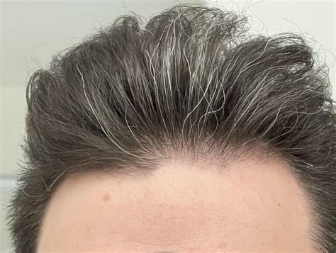 Is It Normal To See Scalp Under Light at David Desantis blog