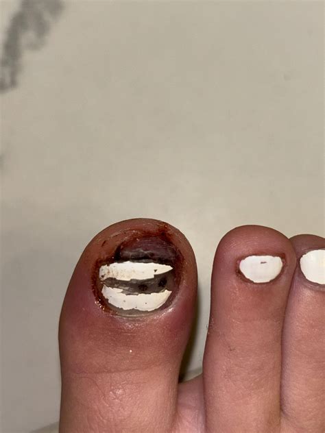 Slammed Toe in Door - **PICTURE IS DISTURBING** : r/medical_advice