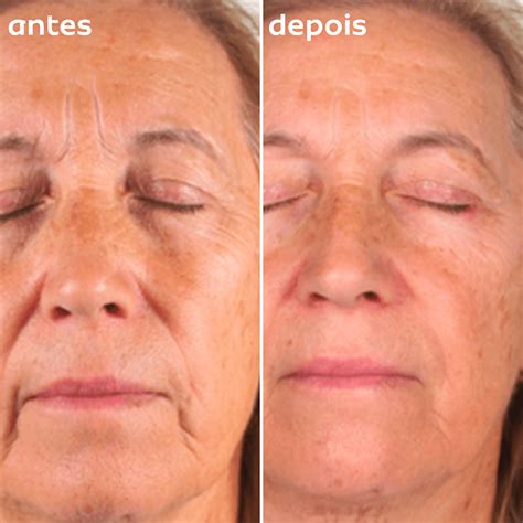 Vitacid Antes E Depois Rugas - Preenchedor de Rugas Bisyou: antes e depois!
