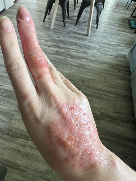 After two years with great skin, I’m back on the eczema scene, weeping
