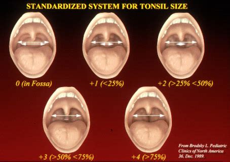 classification system  tonsil size