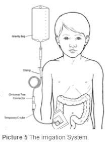 cecostomy ideas gtube feeding tube gtube feeding