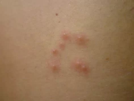 Pequenas Bolinhas No Corpo Que Coçam - Bolhas no corpo de uma criança (16 fotos): aparência nos braços, pernas ...