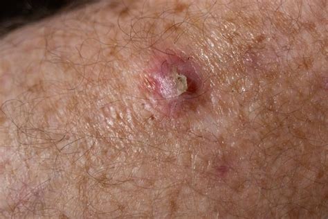 How Dangerous Is a Squamous Cell Carcinoma?: Manhattan Dermatology ...