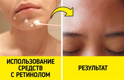 Как избавиться от ненавистных белых прыщиков на лице / Зона комфорта