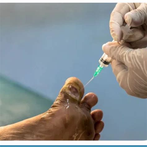 Decoding Diabetic Foot Ulcer ICD10: Key Insights for Healthcare Professionals