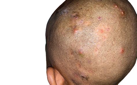 Folliculitis Scalp