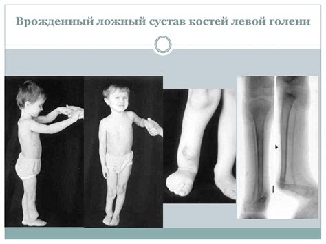 Ложные суставы (псевдоартроз) - презентация онлайн