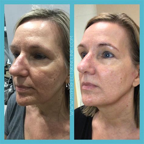 Facials Near Me, Facials Acne, Anti-aging, skin care | Gilbert AZ