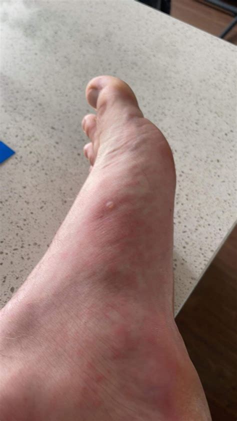 Potential rash after increasing dose (50mg to 75mg) - should I stop
