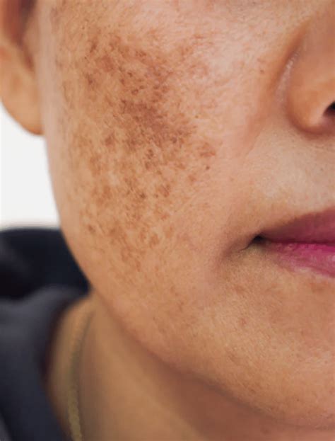 What is Melasma? | Dr. Maryam Zamani