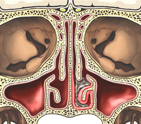 Inflamed Nasal Turbinates