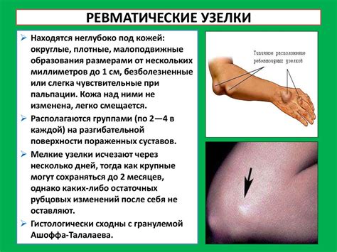 Ревматизм, ревматический кардит, ревматический полиартрит ...