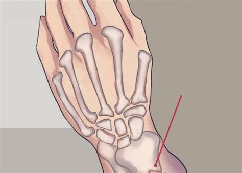 ЛФК при переломе лучевой кости: советы специалиста