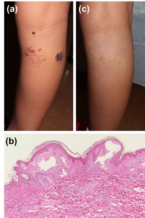 Cutaneous Angiokeratoma Treated With Surgical Excision and a 595-nm