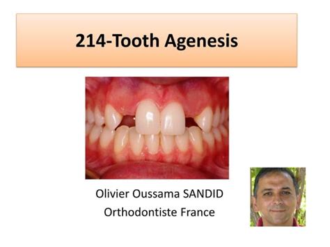 214-missing-teeth-Tooth Agenesis agenesis- agenesie dentaire dental ...