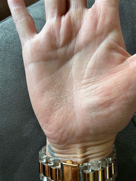 Cracked hands : r/wheelchairs