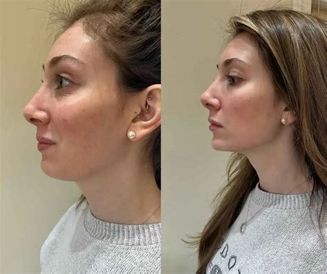 jawline filler     cost results