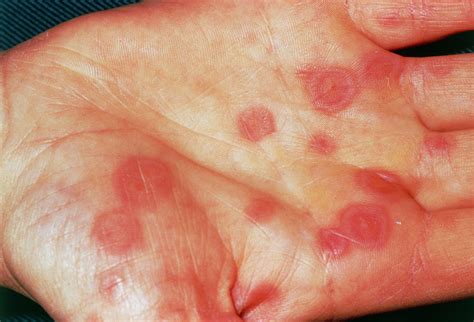 Erythema Multiforme Rash Photograph by Science Photo Library - Pixels