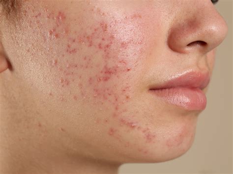 Vyrážka na obličeji: příčiny a léčba u dětí i dospělých | Pilulka.cz