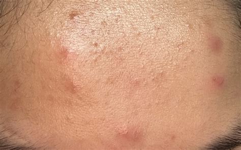 Recent breakout on Forehead/cheek acne help? – Acne – Acne.org Forum