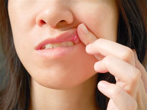 how to get rid a canker sore fast