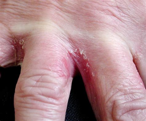 Contact Dermatitis - Dermatologic Disorders - Merck Manual Professional