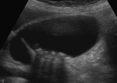 Abdomen and retroperitoneum | 1.2 Gallbladder and bile ducts : Case 1.2.6 Gallbladder ...