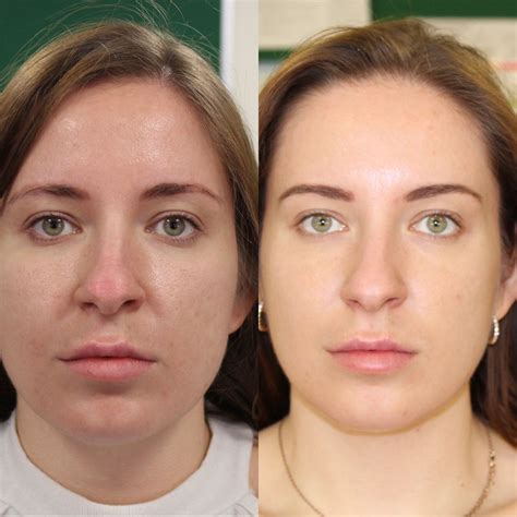 Hydrate Your Skin With Skin Boosters in Bedfordshire!