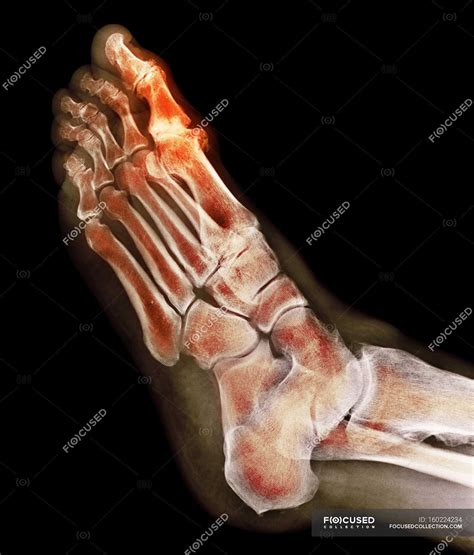 Degenerative foot deformation, X-ray — section, radiological - Stock