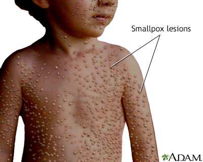 Smallpox Information | Mount Sinai - New York