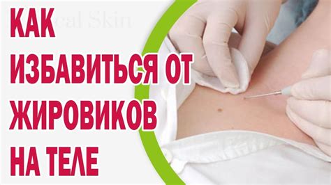 Как избавиться от появившихся на теле жировиков - YouTube