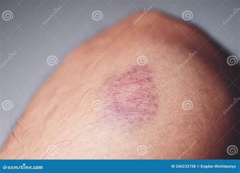 bruised wound   knee  boy fell  scratched  knee stock