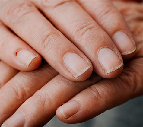 ¿Estrías en las uñas? - Unglax: Nail Experts